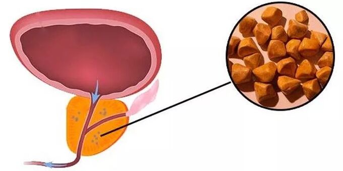 Pierres de la prostate
